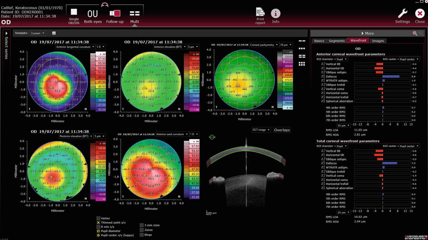 especialistas lentes esclerales asturias