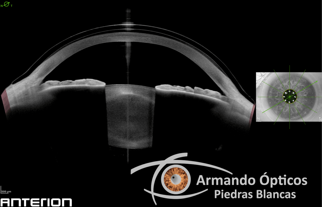 La mejor tecnología para adaptación de lentes de contacto especiales.