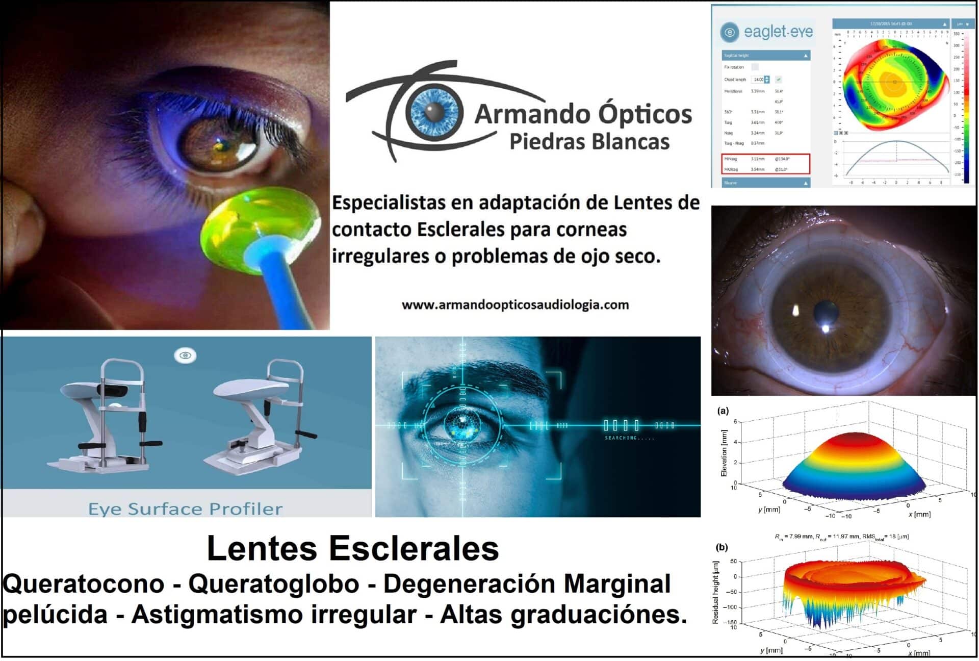 Lentes de contacto queratocono Asturias, Avilés, Gijón y Oviedo