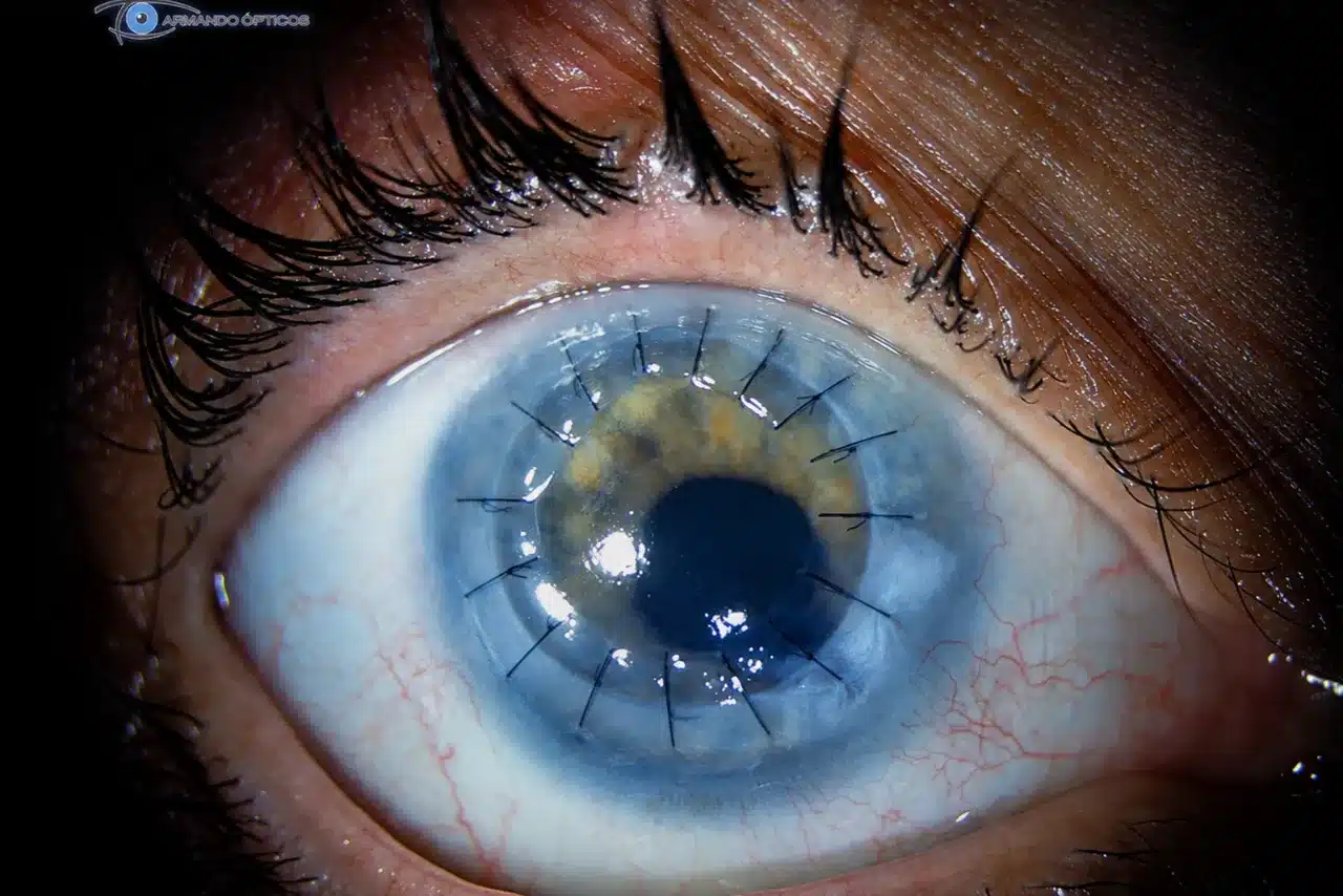 Imagen clínica del ojo utilizada para la evaluación y seguimiento de la salud visual